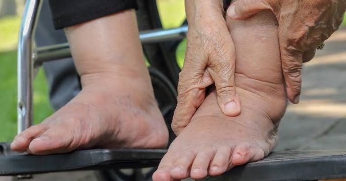 Importante evitar retención de líquidos por falta de actividad física: IMSS