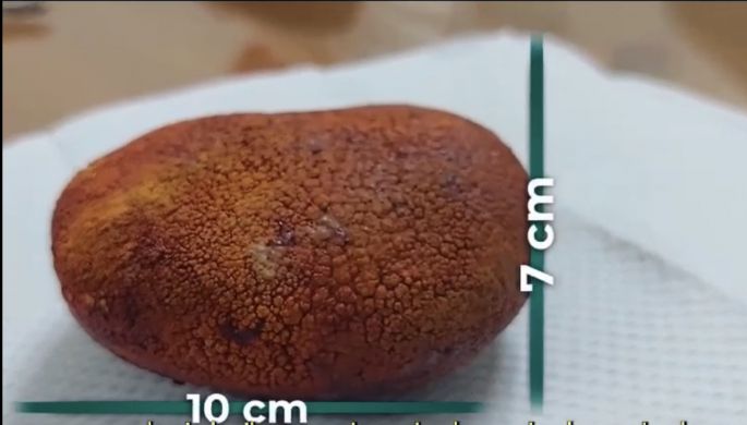 Extraen piedra gigante de 250 gramos de vejiga de adulto mayor