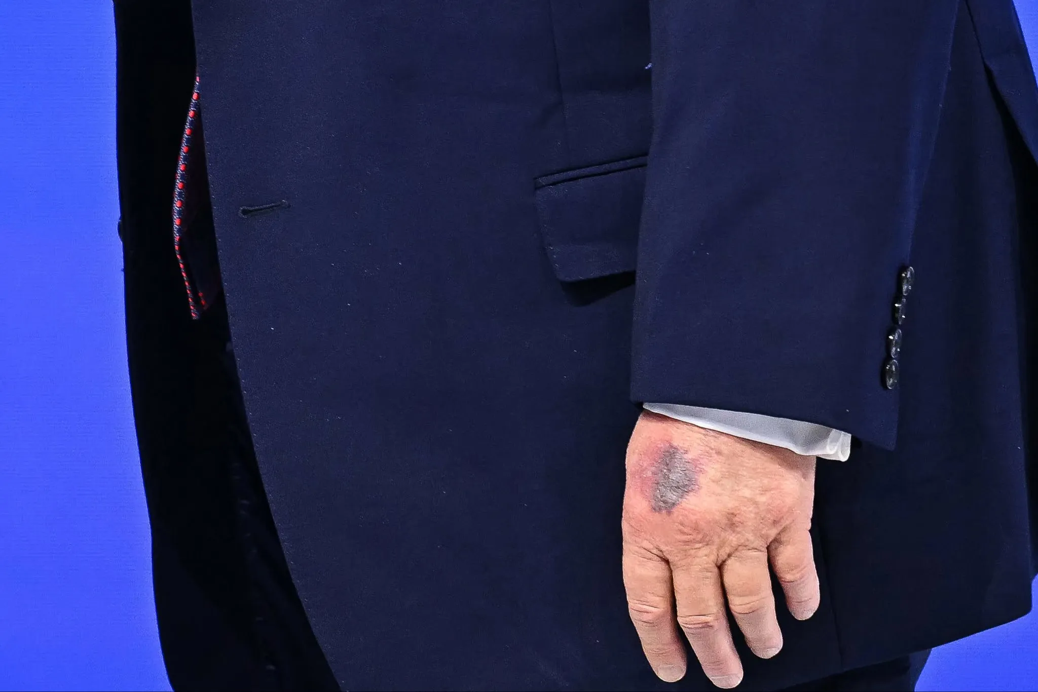Trump aparece con moretón en su mano y desata especulaciones sobre su salud